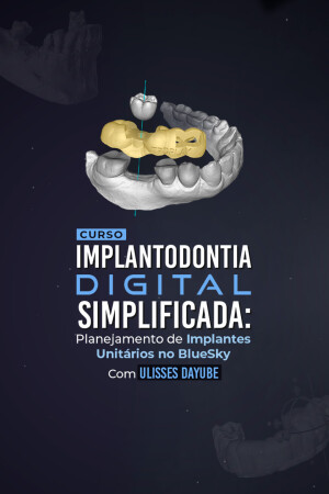 Implantodontia Digital Simplificada