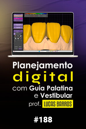Planejamento Digital com Guia Palatina e Vestibular